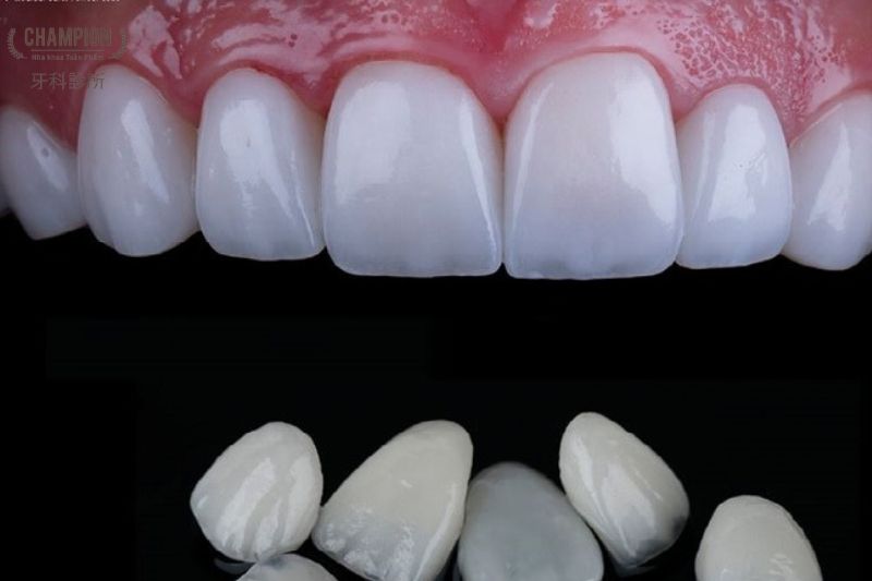 When Should Porcelain Veneerss Be Used?
