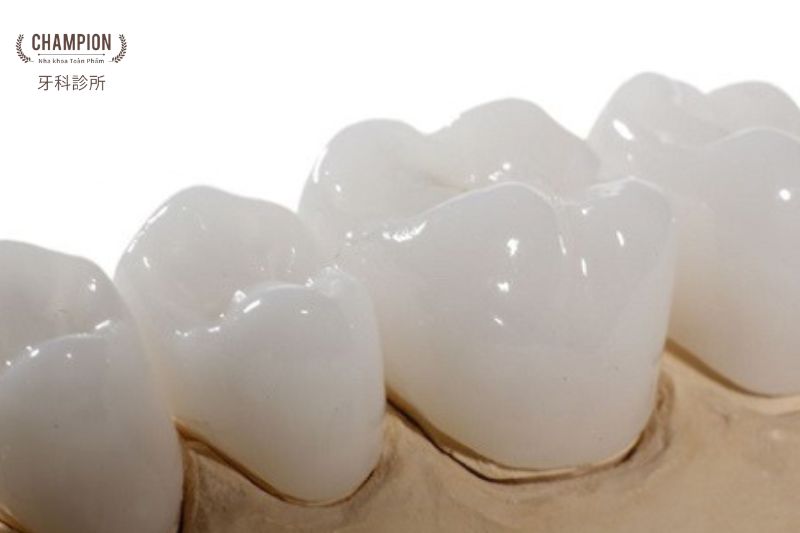 Răng sứ Venus có thực sự tốt không?