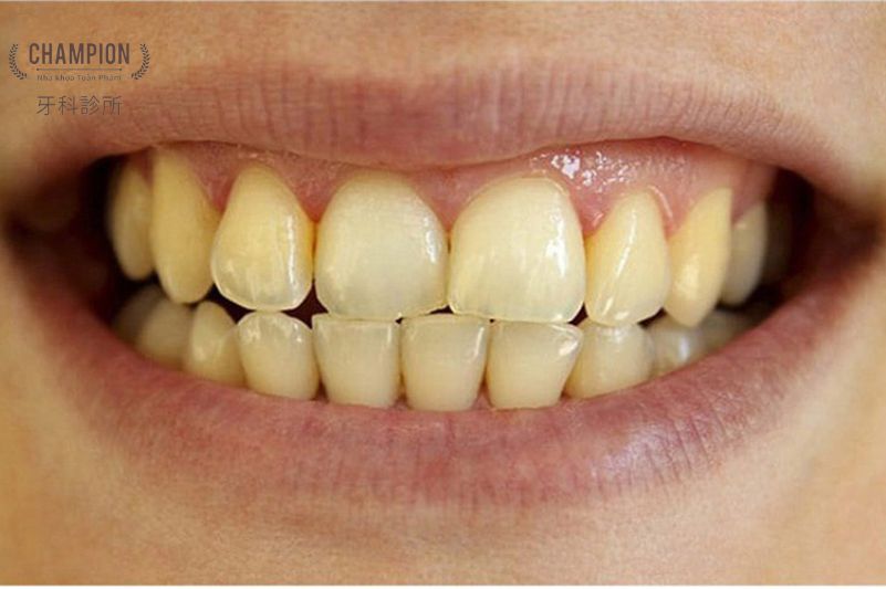 Có thể tẩy trắng răng được không?