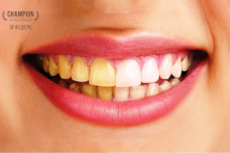 Những hậu quả khi răng bị ố vàng do hôi miệng