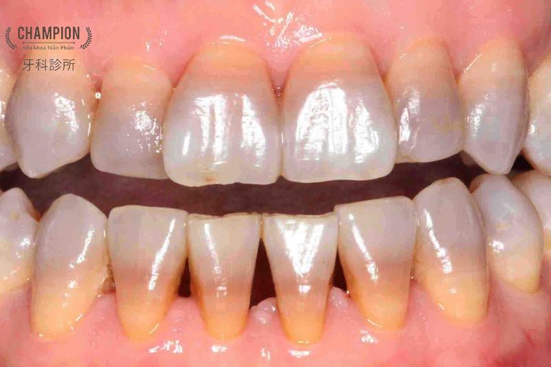 Răng bị xỉn màu là gì?