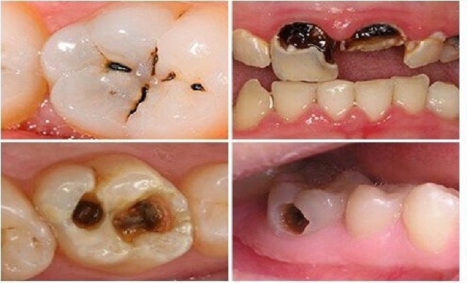 Sâu răng và tác hại không được chữa trị