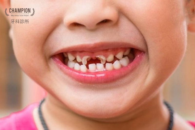 Lý do cần phải chăm sóc răng sữa cho trẻ em 