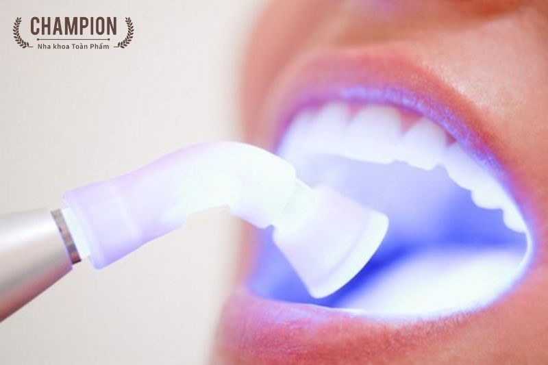 Công nghệ tẩy trắng răng bằng laser là gì?