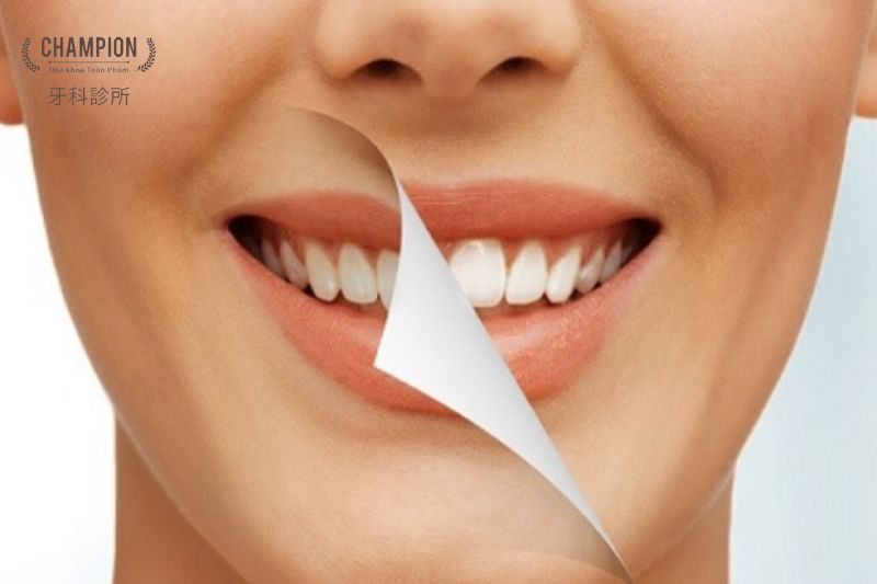 Các phương pháp tẩy trắng răng