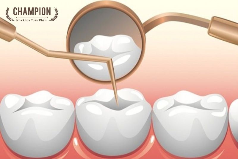 Quy trình trám răng sau khi chữa tủy