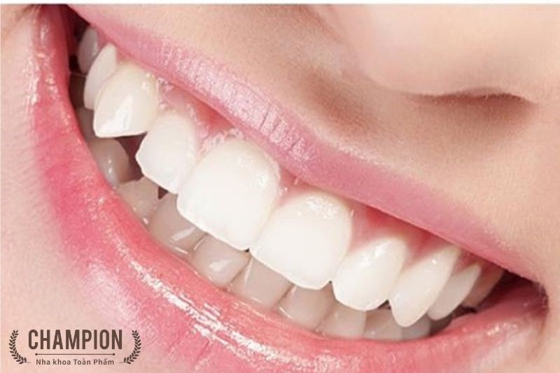 Trám răng thẩm mỹ là gì? Nên trám răng khi nào?
