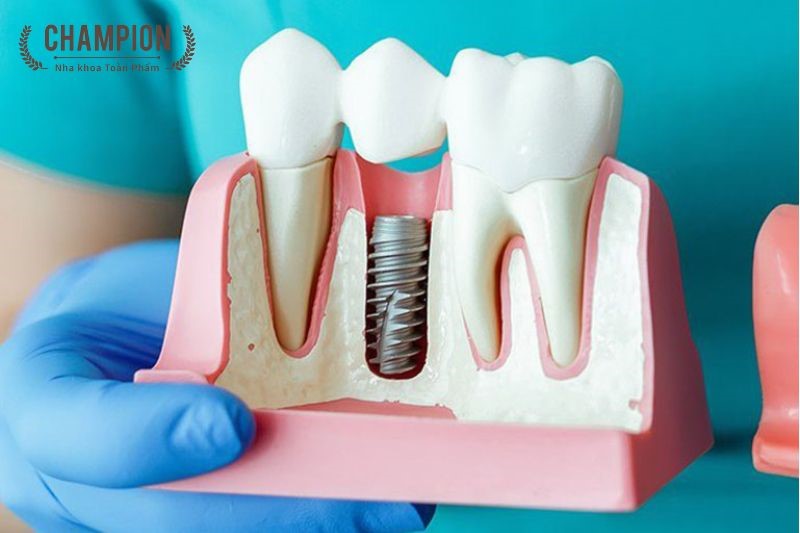 Ưu điểm của trồng răng Implant