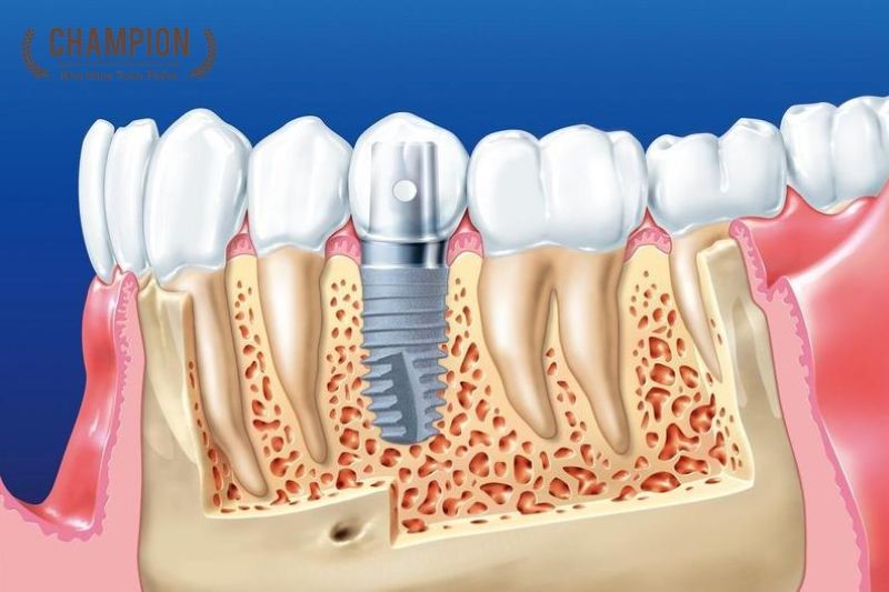 Quy trình trồng răng Implant tại Nha khoa Champion