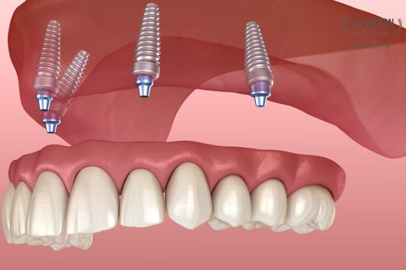 Ưu điểm nổi bật của kỹ thuật trồng răng Implant all-on-4