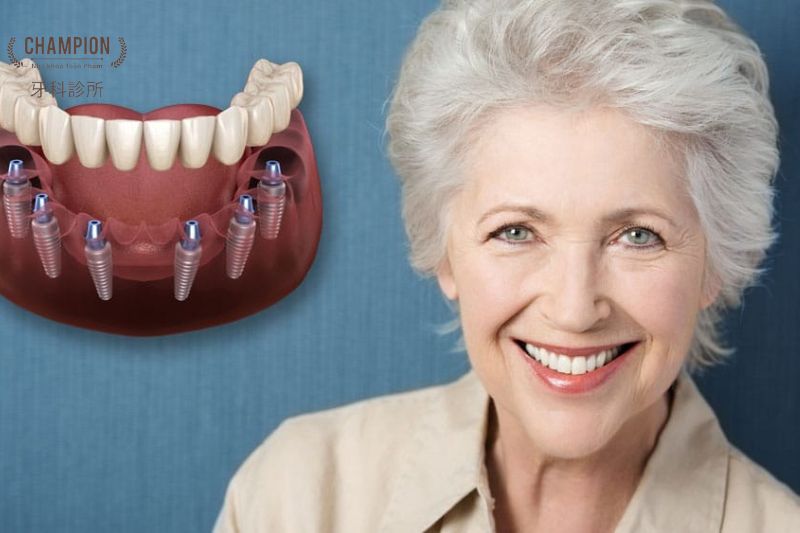 Trồng răng Implant All-On-6 là gì? 
