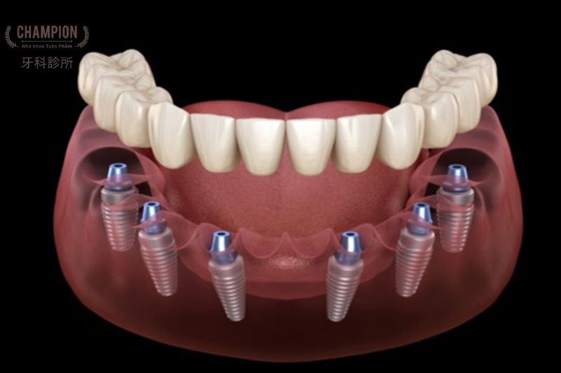Các đối tượng nên trồng răng Implant All-on 6