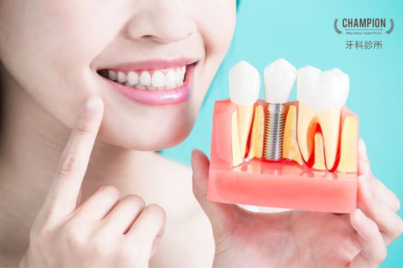 Bác sĩ thực hiện cấy ghép Implant