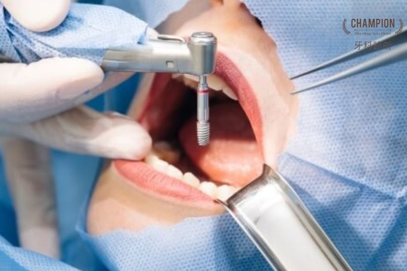Trồng răng Implant đơn lẻ là gì?