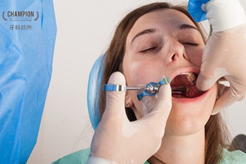 Ưu điểm nổi bật của kỹ thuật trồng răng Implant đơn lẻ