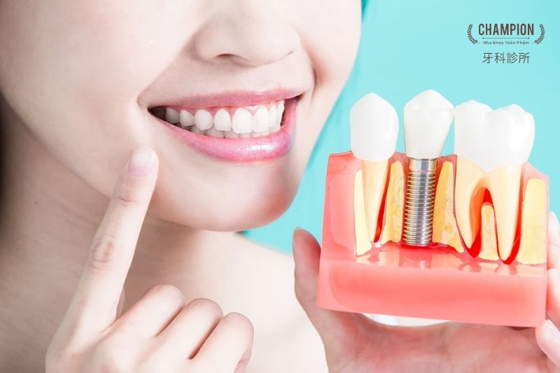 Where to Get High-Quality Dental Implants in Ho Chi Minh City?