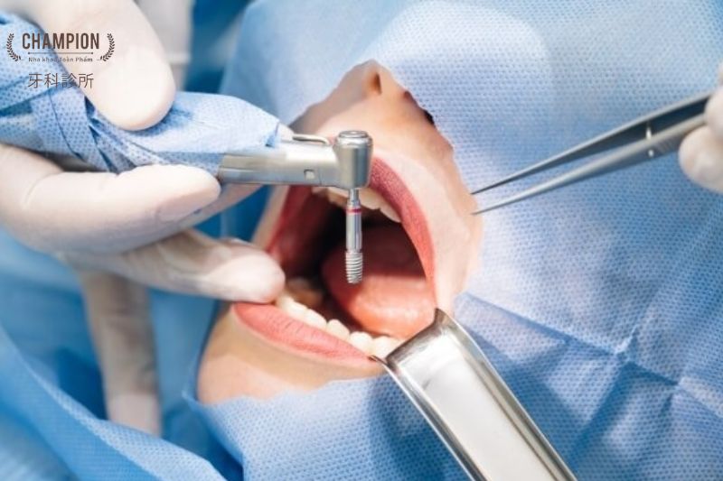 How to Choose a Reputable Dental Implant Center?