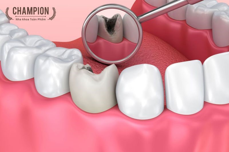 Khi nào cần chữa tủy răng lại?