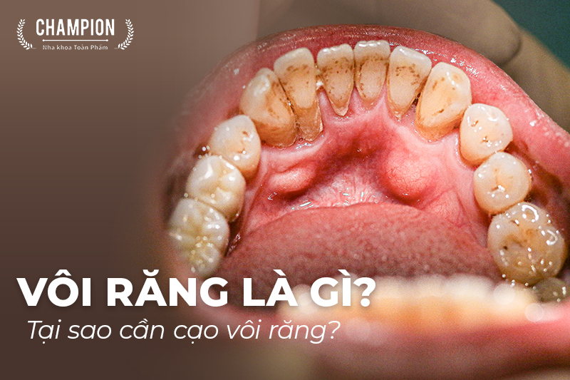 voi-rang-la-gi-tai-sao-can-cao-voi-rang