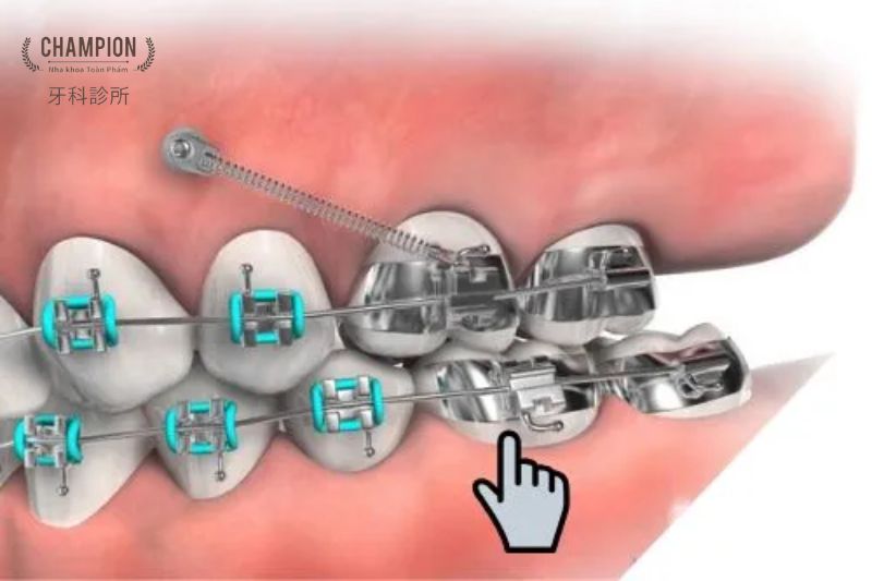 Tìm hiểu band niềng răng là gì?