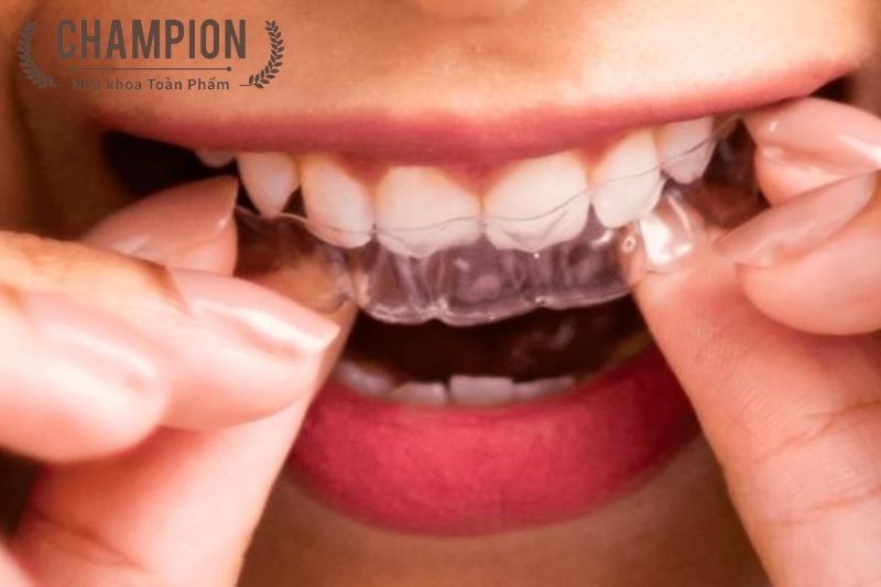 5 Things you must know prior to experimenting with invisible braces 