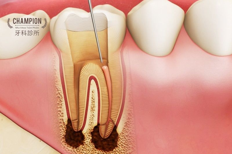 Các biến chứng thường gặp của bệnh viêm tủy răng và ảnh hưởng tới sức khỏe tổng thể