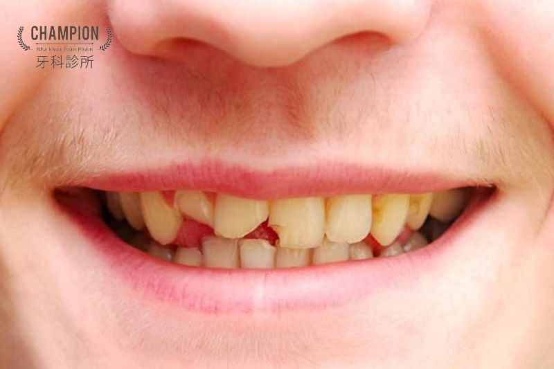 Bật mí các cách điều trị mẻ răng hiệu quả giúp phục hình nhanh chóng