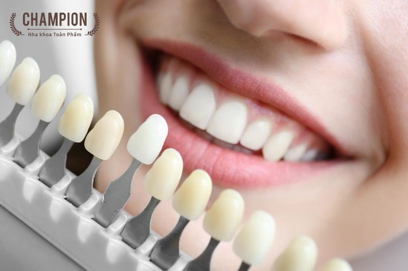 Hướng dẫn cách sử dụng máng tẩy trắng răng tại nhà từ chuyên gia