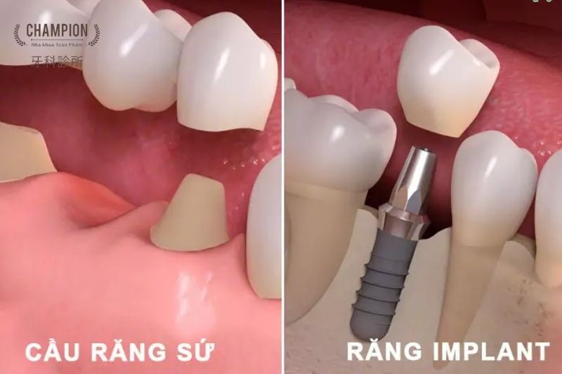 Compare Dental Ceramic Crowns and Dental Implants
