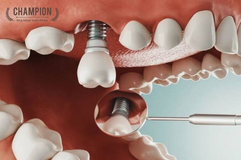 Chi phí trồng răng implant tại nha khoa Champion