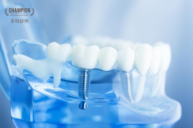 Những trang thiết bị máy móc cần có cho việc cấy ghép implant nha khoa