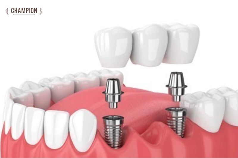 Một số yếu tố ảnh hưởng đến thời gian cấy ghép Implant