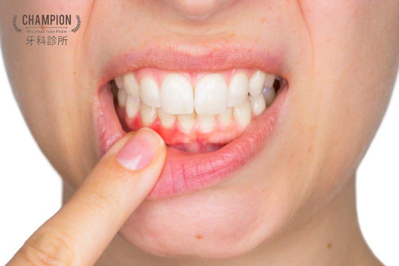 Chảy máu chân răng: Nguyên nhân và cách xử lý hiệu quả