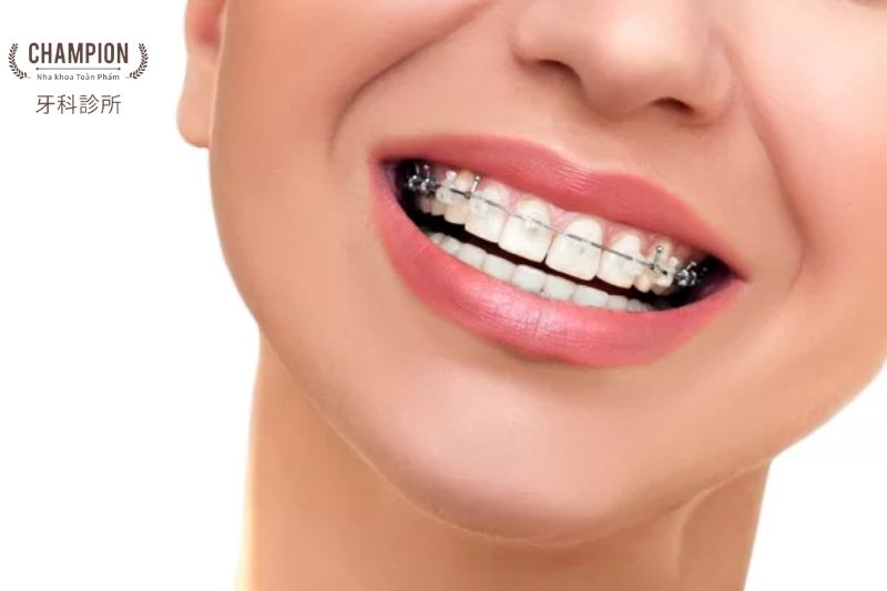 Chi phí điều trị răng quá khít: Các yếu tố ảnh hưởng và cách tiết kiệm