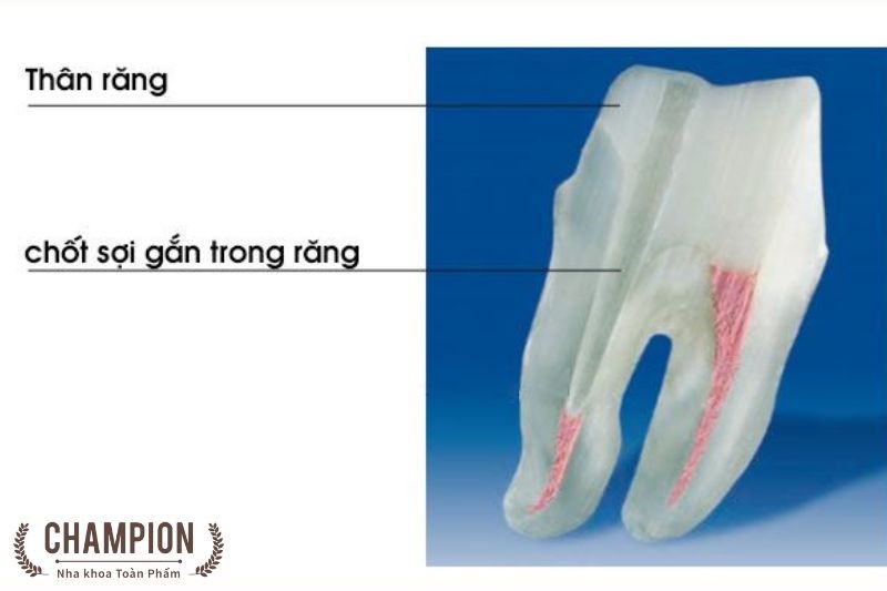 Chốt sợi thủy tinh là gì?