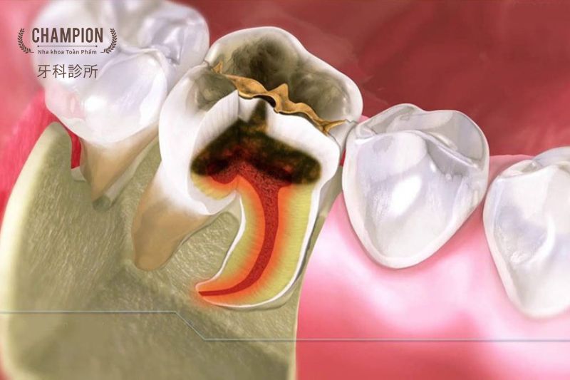 Các tiêu chí lựa chọn địa chỉ chữa tủy răng an toàn tại Quận 7