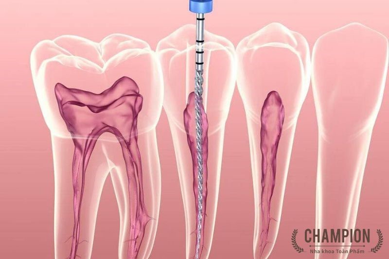 Chữa tủy răng cối nhỏ là gì?