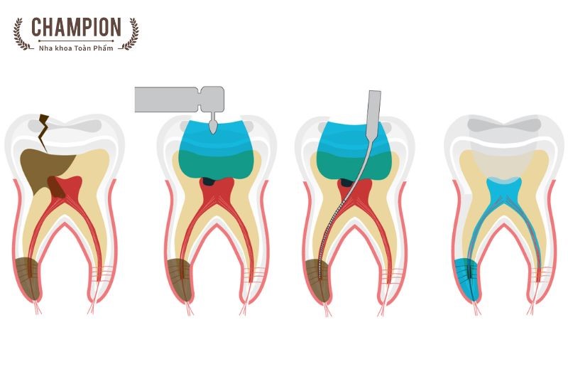 Lấy tủy răng cửa tại nha khoa Champion diễn ra như thế nào?