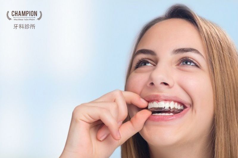 Có nên niềng răng Invisalign không?