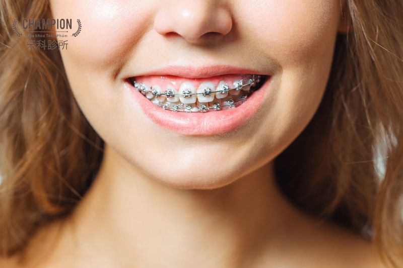 Có nên niềng răng khi bị răng quá khít? Những điều bạn cần biết
