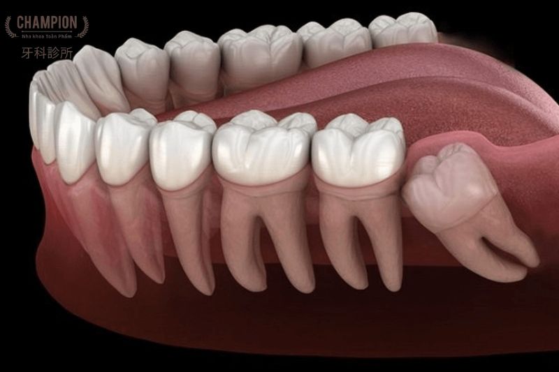 Dấu hiệu mọc răng khôn dễ nhận biết nhất