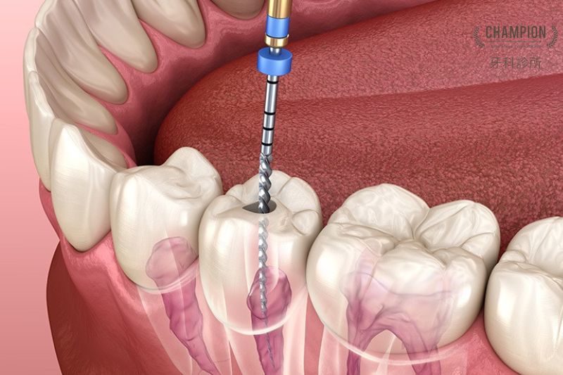 Điều trị nội nha là gì?