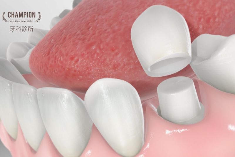 5 Phương pháp điều trị nứt răng được áp dụng nhất 2024