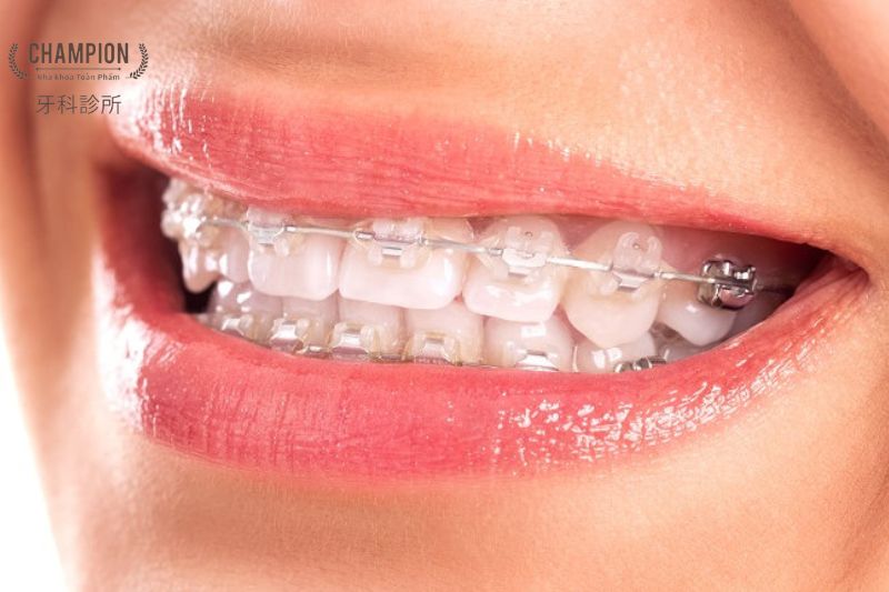 5 lợi ích bất ngờ mà bạn có được khi điều trị răng quá khít 