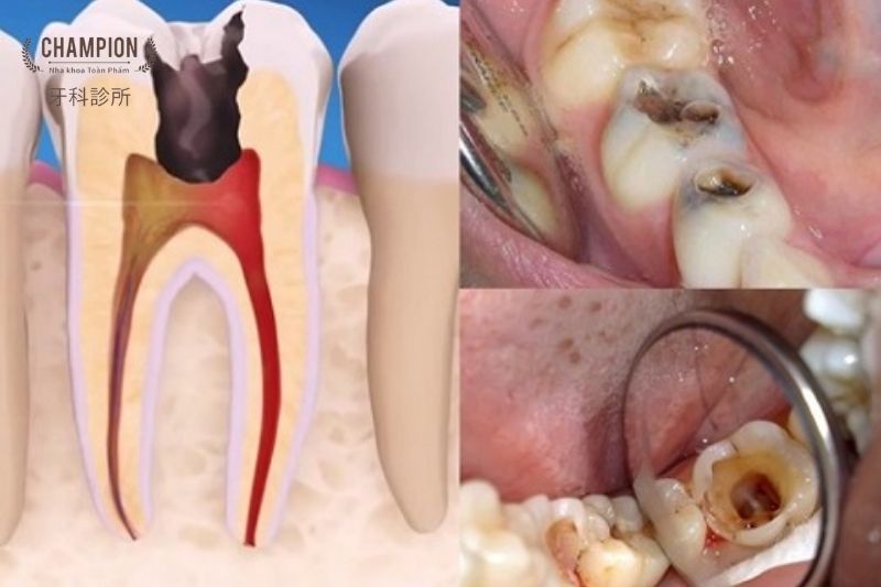 Endodontics Treatment: Champion Dental Clinic in District 7