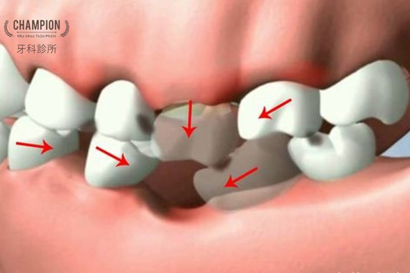 Hàm răng bị xô lệch là gì?