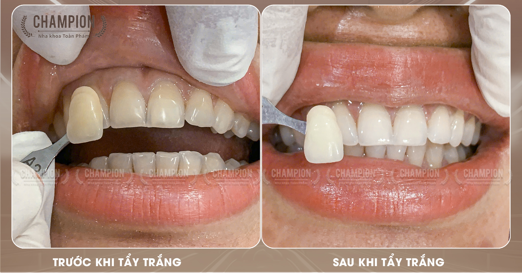 Khách hàng thực hiện dịch vụ tẩy trắng răng tại Phòng khám Champion Dental Clinic
