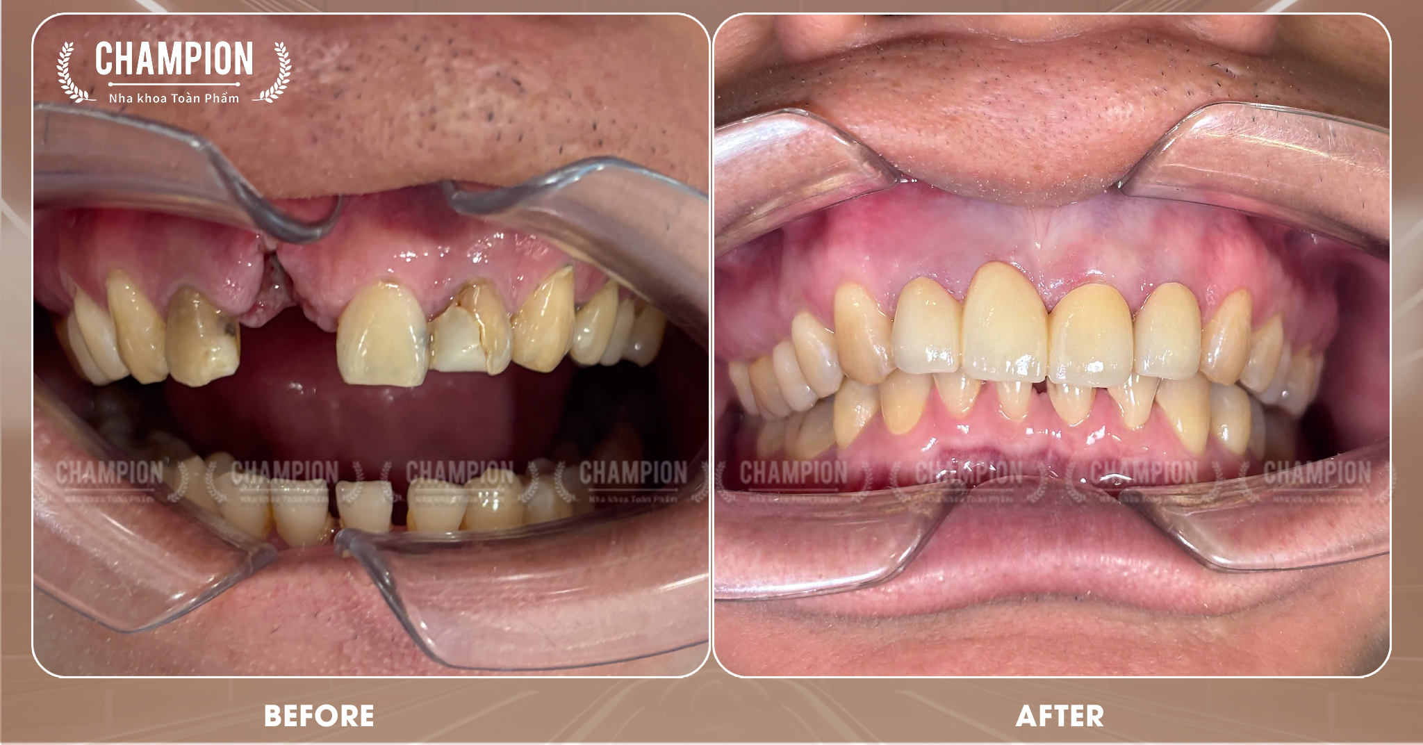 Khách hàng thực hiện dịch vụ trồng răng sứ tại Champion Dental Clinic