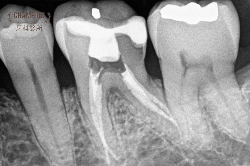 Nguy hiểm của hoại tử tủy răng và những biến chứng có thể gặp