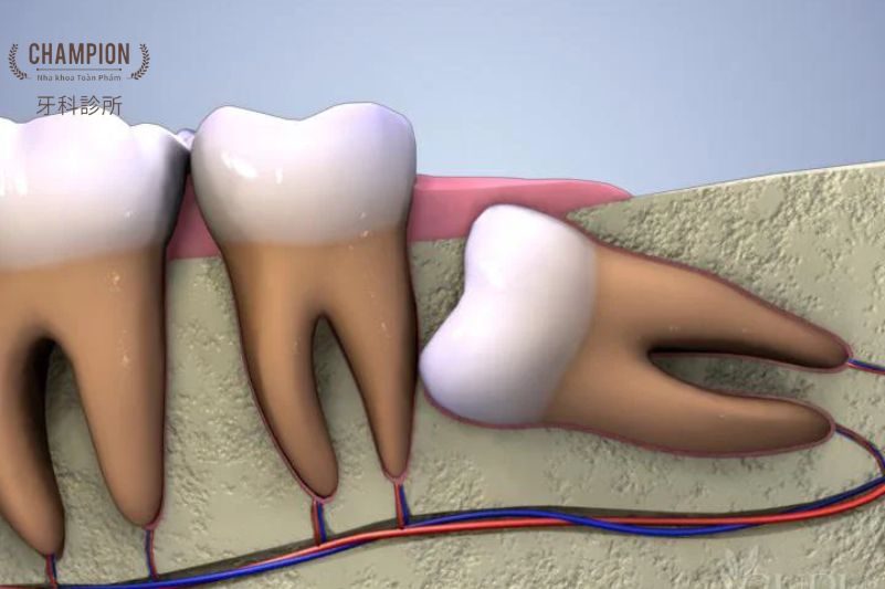 Hiểu đúng về tình trạng răng khôn mọc lệch